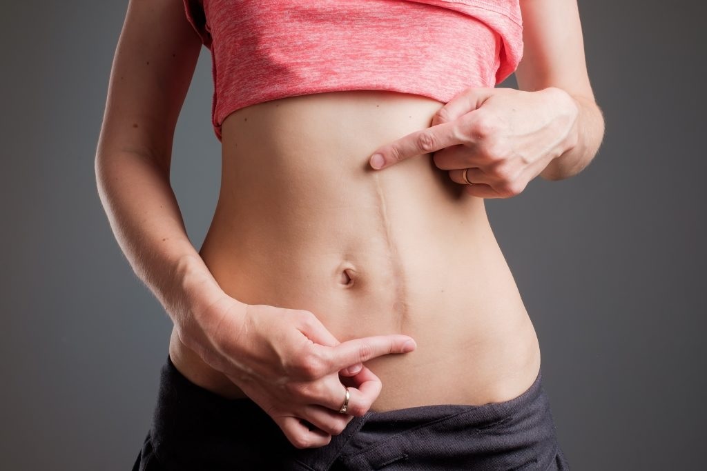 Liposuction Costs in Delhi