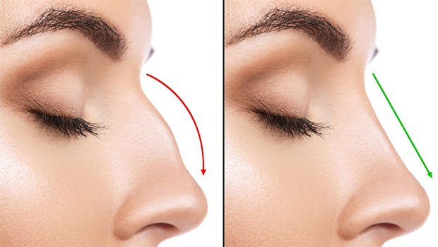 Rhinoplasty Surgery in Delhi