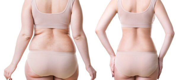 liposuction-cost-in-delhi