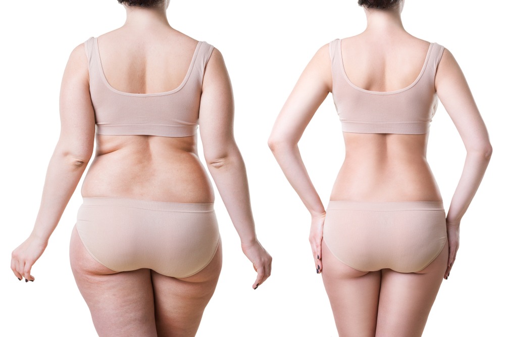 liposuction-cost-in-delhi